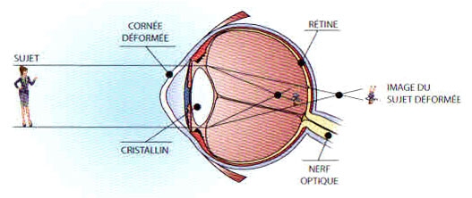 Schéma de l'astigmatisme