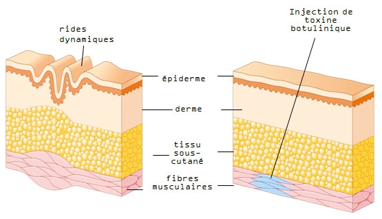 Schéma de la formation des rides dynamiques