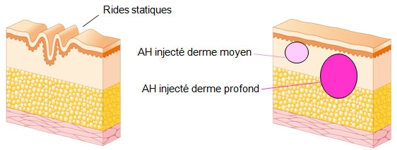 Schéma de la formation des rides statiques