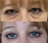 Blépharoplastie