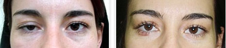 Ptosis : opération de chirurgie réparatrice des paupières